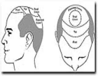 How Many Grafts Do I Need for My Hair Transplant?