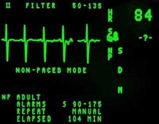 Heart Disease and Electrocardiogram
