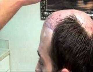 Five Ways To Know Is Hair Transplant Is Right For You