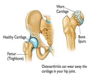 Does a hip replacement in India provide effective results?