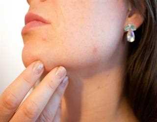 Cranker Sores: Symptoms and Causes