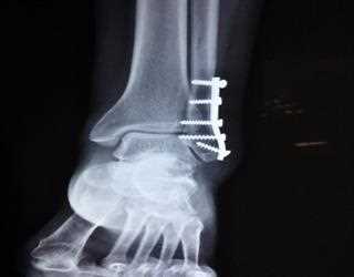 Bone Fractures: Types, Symptoms and Causes