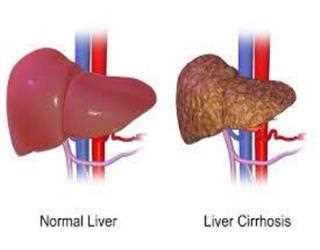 Top 11 Liver Cancer Specialists in India