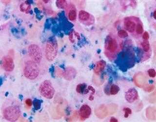 Best Hospitals Or Places For Bone Marrow Transplant In India