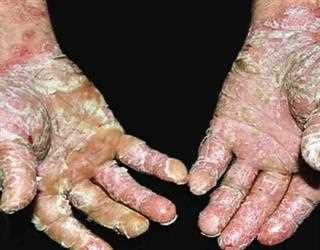 Natural Home Remedies And Tips For Psoriasis