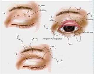 Tips to Get the Best Eyelid Surgery Korea Cost