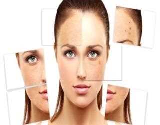 Causes Of Melasma