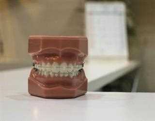 5 Ways to Keep Your Braces Clean