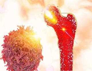 Where Can I Receive Most Affordable Bone Marrow Transplant?