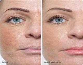 The 3D Lip Permanent Makeup Boca Raton refreshes entire face