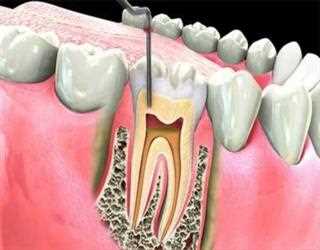 Root Canal: Explanation of Root Canal Procedure
