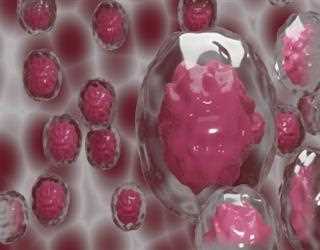 After a stem cell transplant, the first woman is said to be HIV-free.