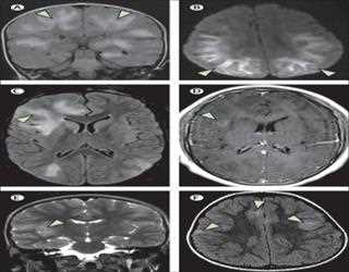 Important Post-COVID Brain Abnormalities Discovered by Special MRI